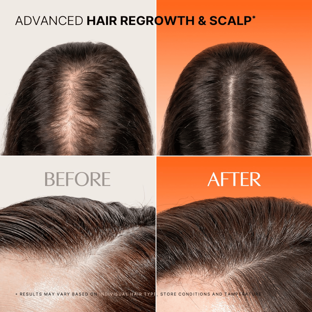 Image avant/après des cheveux et du cuir chevelu lors de l’utilisation de LILYEVE Grow Turn Exosome Spicule Ampoule 3000.